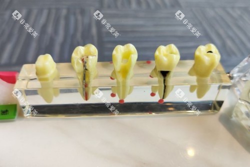 烟台刘芳口腔牙齿模型
