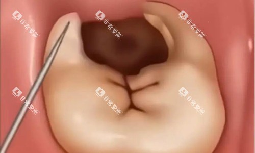 牙齿龋齿卡通图
