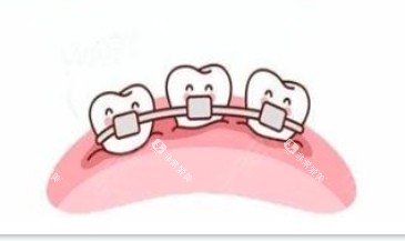 隐形牙齿和传统牙齿矫正器展示图