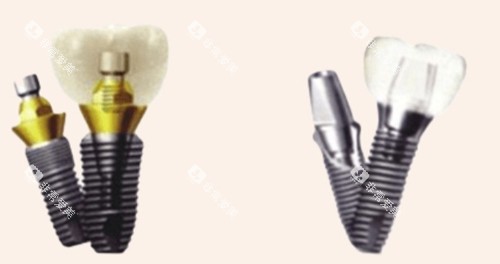 不同材质的种植牙 不同材质的种植牙