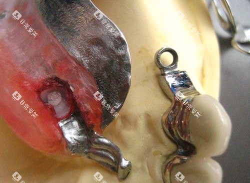 假牙挂钩细节图 假牙挂钩细节图