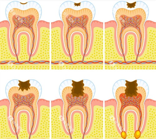 牙齿逐步变蛀牙过程 牙齿逐步变蛀牙过程