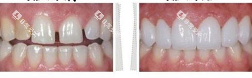 牙齿贴面前后示意图 牙齿贴面前后示意图