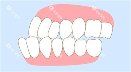 牙齿错颌畸形照片 牙齿错颌畸形照片