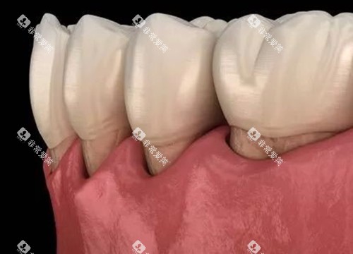 牙龈萎缩卡通示意图