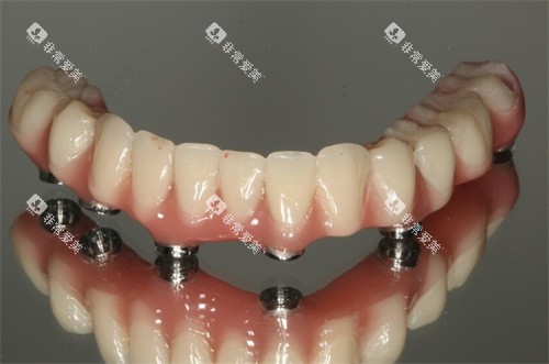 全口种植牙下颌