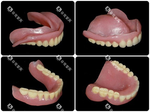 全口吸附性义齿实物展示图 全口吸附性义齿实物展示图