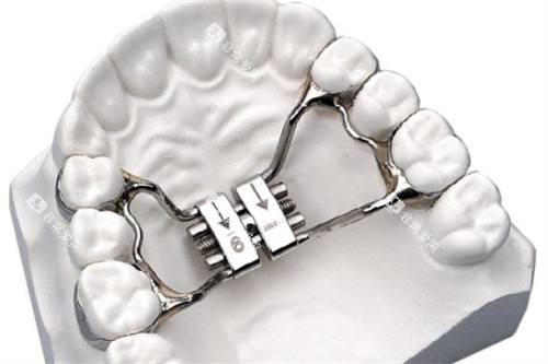 MSE扩弓器展示图