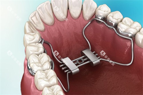 MSE扩弓器安装图