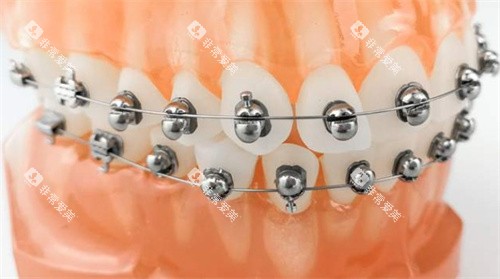 球面自锁托槽矫正 球面自锁托槽矫正
