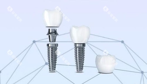 口腔种植牙改善 口腔种植牙改善