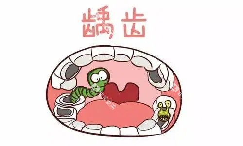 牙齿龋齿示意图