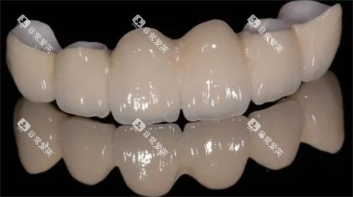 东莞石排莞口口腔烤瓷牙的颜色和光泽