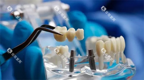 种植牙植体和牙冠安装模型示意图 种植牙植体和牙冠安装模型示意图