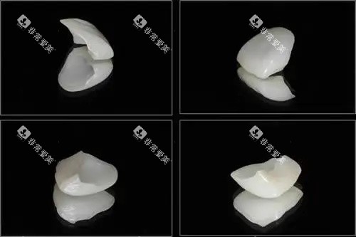 贴面示意图 贴面示意图