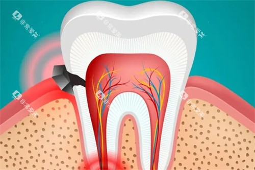 牙痛的急救措施