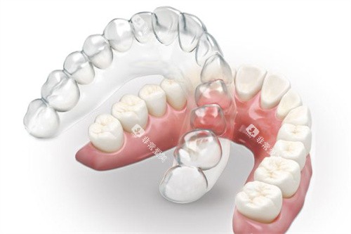 隐形矫正牙套 隐形矫正牙套