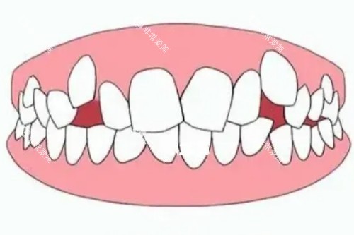 牙列拥挤模型图