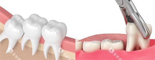 拔掉歪斜的智齿
