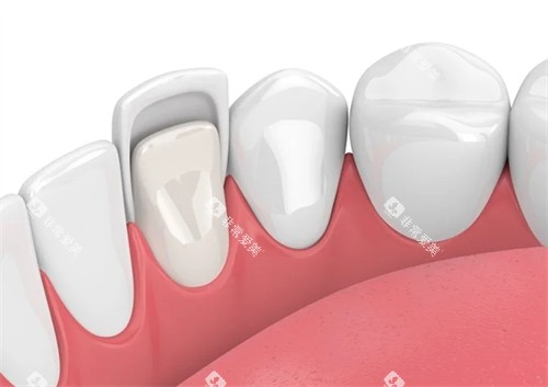 牙齿贴面在口腔内的样子
