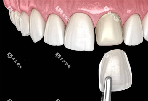 单颗牙齿贴面图