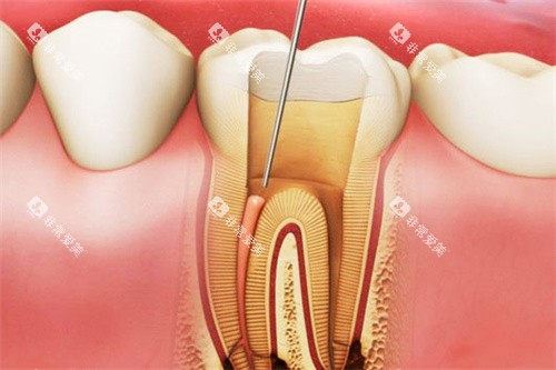 根管治疗牙神经图