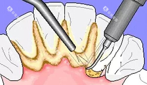 牙结石超声波洁牙示意图