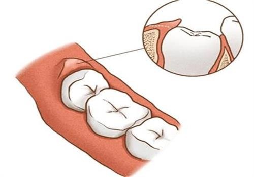 阻生齿冒出图