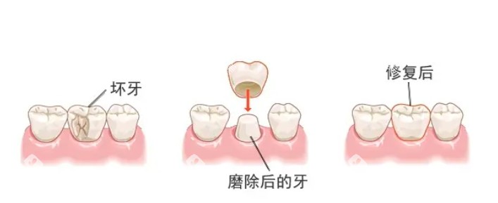 牙冠修复演示图