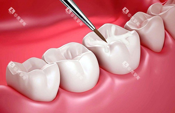 窝沟封闭保护牙齿