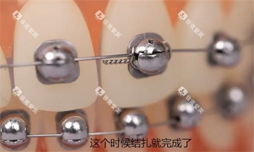 球面自锁托槽矫正近距离