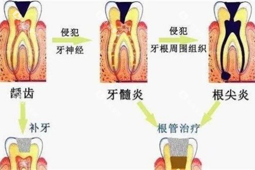 牙髓炎的治疗方法