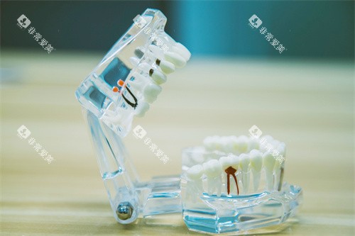 根管治疗牙齿模型