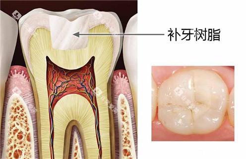 补牙树脂结果图