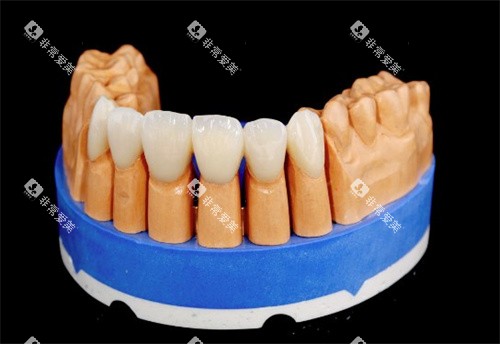 泽康二代全瓷牙