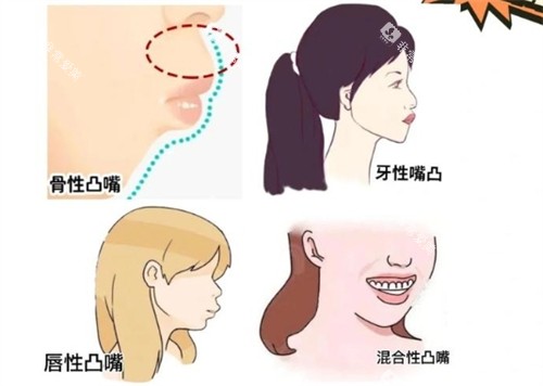 不同类型的凸嘴 不同类型的凸嘴