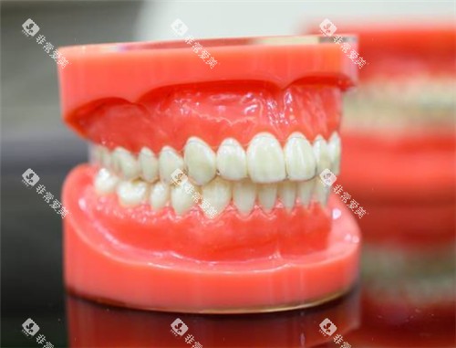 隐形矫正牙套佩戴模型展示图 隐形矫正牙套佩戴模型展示图