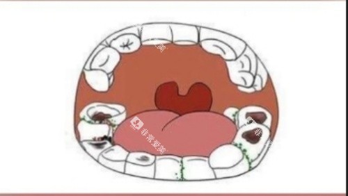 牙齿腐蚀漫画示意图 牙齿腐蚀漫画示意图