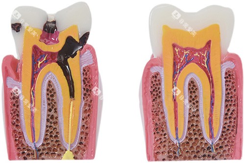 牙根龋坏模型图片