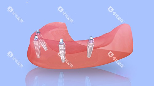 半口种植牙四颗植体植入漫画图 半口种植牙四颗植体植入漫画图