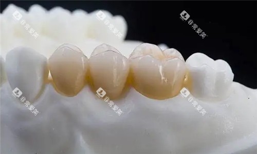 全瓷牙冠图 全瓷牙冠图