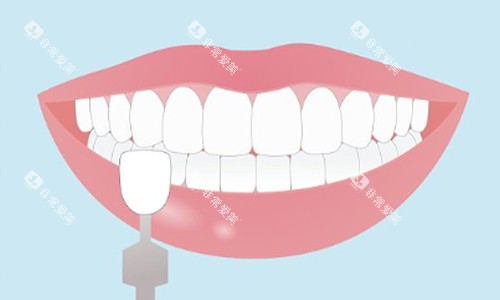 牙齿贴面示意图