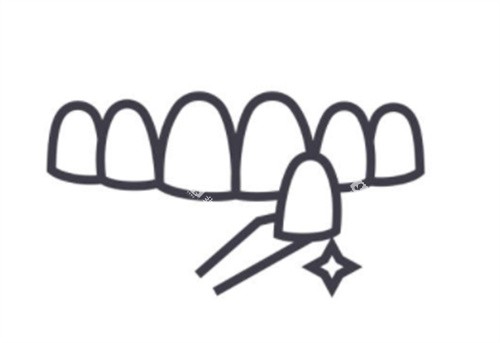 牙齿贴面卡通图 牙齿贴面卡通图