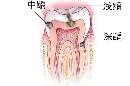 牙齿龋齿深浅图
