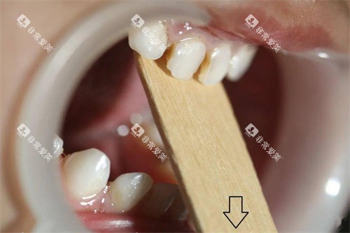 地包天咬撬法训练示意图