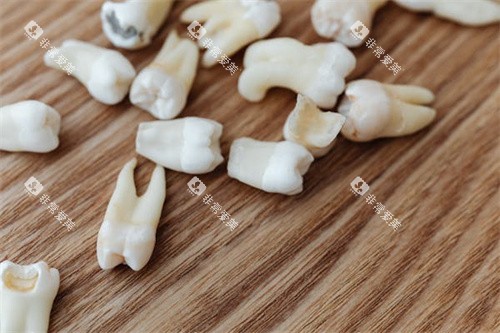 正畸牙齿模型