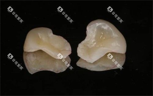 树脂嵌体实物展示图 树脂嵌体实物展示图