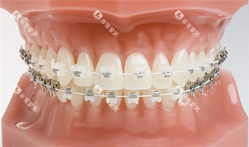 Ceramic-Braces-1