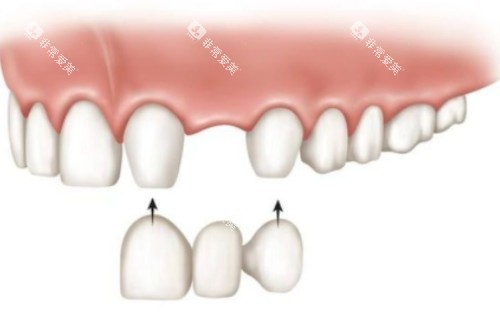 镶牙安装卡通图 镶牙安装卡通图