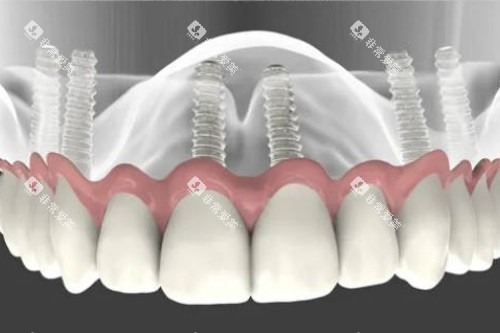 all-on-6种植模型图